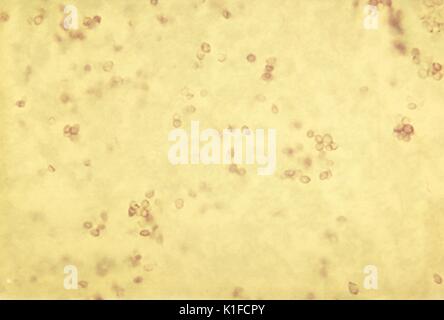 Yeast forms of Histoplasma capsulatum in tissue. Histopathology of histoplasmosis showing yeast forms of Histoplasma capsulatum . This fungus shows thermal dimorphism: mold form at 25{degrees}C and yeast form at 37{degrees}C. Image courtesy CDC. 1982. Stock Photo