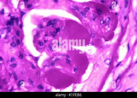 Light micrograph of a human kidney showing amyloid deposits (pink) in a ...