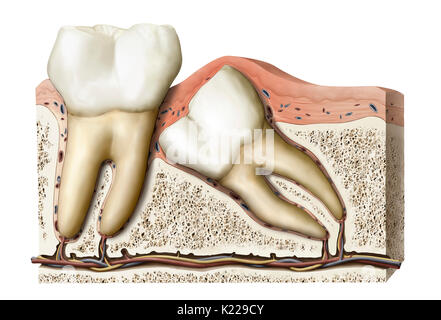 While growing, the wisdom teeth can remain under the gums or in the bone, or even pop up in an abnormal position. Stock Photo