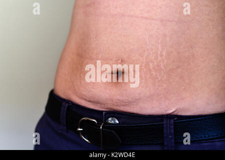 Woman belly with stretch marks and scars after pregnancy,weight loss and piercing Stock Photo