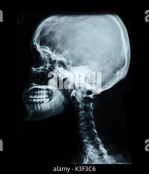 Human skull X-ray image isolated on black (skull, head, xray) Stock Photo