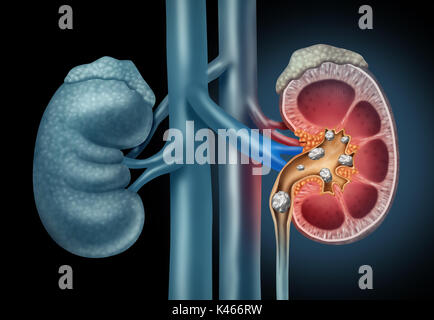Human Kidney stones medical concept as an organ with painful crystaline mineral formations as a medicine symbol with a cross section. Stock Photo