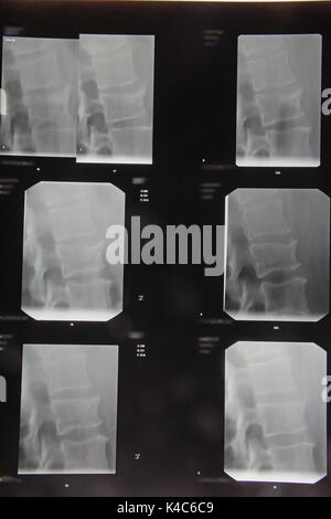 Radiography Stock Photo