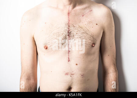 Some Scar from open heart surgery in studio Stock Photo