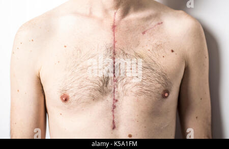 Some Scar from open heart surgery in studio Stock Photo
