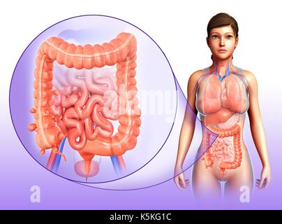 Illustration of a woman with diverticulosis in the first part of the large intestine. Stock Photo