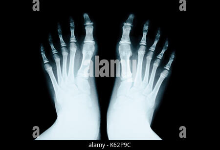 X-RAY of foot human on black. Stock Photo