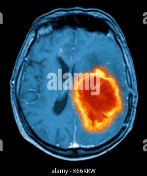 Brain tumour. Coloured Magnetic Resonance Imaging (MRI) scan of an axial section through the brain showing a metastatic tumour. At bottom left is the tumour (red-yellow) This tumour occurs within one cerebral hemisphere; the other hemisphere is at right. The eyeballs - not visible -are at top. Metastatic cancer is a secondary disease spread from cancer elsewhere in the body. Metastatic brain tumours are malignant. Typically they cause brain compression and nerve damage Stock Photo