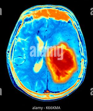 Brain tumour. Coloured Magnetic Resonance Imaging (MRI) scan of an axial section through the brain showing a metastatic tumour. At bottom left is the tumour (red-yellow) This tumour occurs within one cerebral hemisphere; the other hemisphere is at right. The eyeballs - not visible -are at top. Metastatic cancer is a secondary disease spread from cancer elsewhere in the body. Metastatic brain tumours are malignant. Typically they cause brain compression and nerve damage Stock Photo