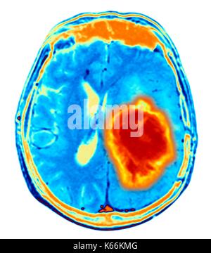 Brain tumour. Coloured Magnetic Resonance Imaging (MRI) scan of an axial section through the brain showing a metastatic tumour. At bottom left is the tumour (red-yellow) This tumour occurs within one cerebral hemisphere; the other hemisphere is at right. The eyeballs - not visible -are at top. Metastatic cancer is a secondary disease spread from cancer elsewhere in the body. Metastatic brain tumours are malignant. Typically they cause brain compression and nerve damage Stock Photo