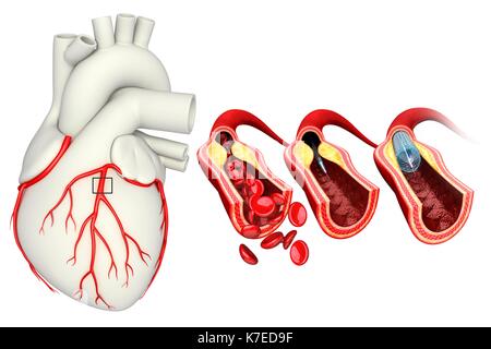 Illustration of coronary angioplasty stent insertion. Stock Photo