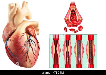 Illustration of coronary angioplasty stent insertion. Stock Photo