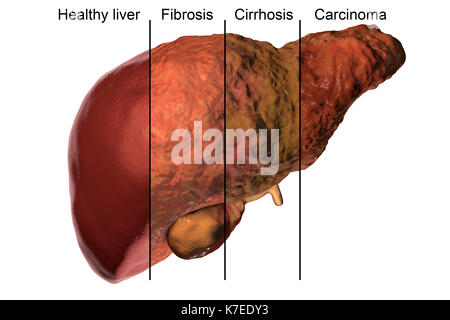 Human liver showing stages of liver disease, computer illustration. Stock Photo