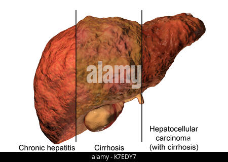 Human liver showing stages of liver disease and a hepatitis virus, computer illustration. Stock Photo