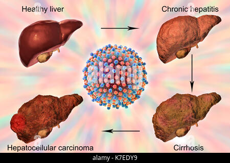 Human liver showing stages of liver disease during hepatitis C viral infection, computer illustration. Stock Photo