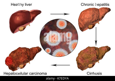 Human liver showing stages of liver disease during hepatitis C viral infection, computer illustration. Stock Photo