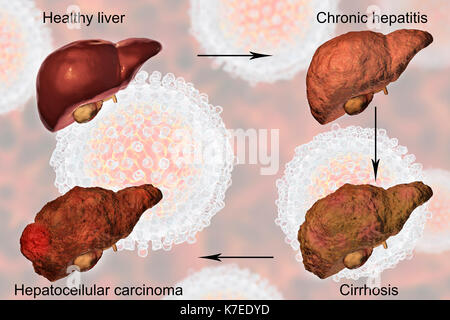 Human liver showing stages of liver disease during hepatitis C viral infection, computer illustration. Stock Photo