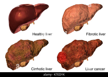 Human liver showing stages of liver disease, computer illustration. Stock Photo