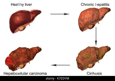 Human liver showing stages of liver disease, computer illustration. Stock Photo