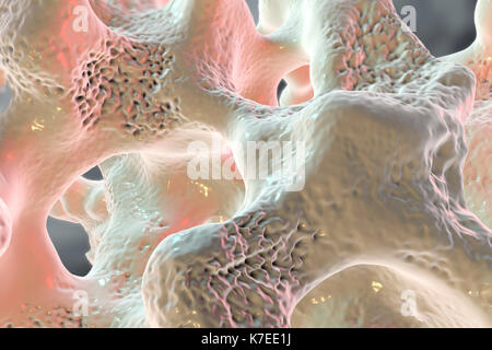Illustration of bone structure affected by osteoporosis. Thinning of ...