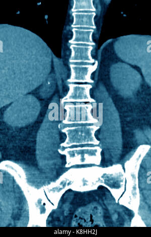 VERTEBRAL OSTEOARTHRITIS, CT-SCAN Stock Photo - Alamy