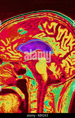 CEREBRAL ATROPHY, MRI Stock Photo - Alamy