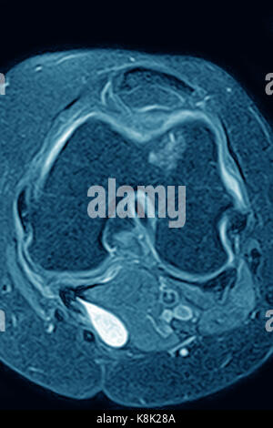 OSSEOUS EDEMA MRI Stock Photo - Alamy