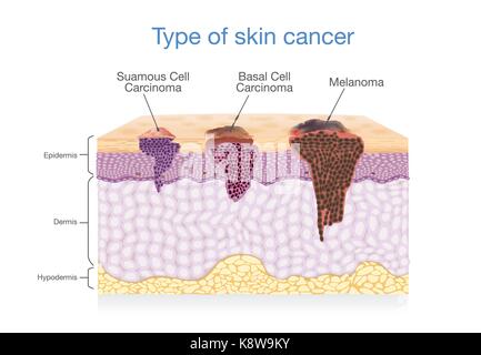 Vector Illustration of Melanoma and Skin Cancer Awareness Month ...