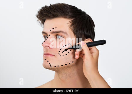 Close-up Of Person Hands Drawing Correction Line With Pen On Male Face For Plastic Surgery Stock Photo