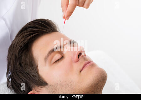 Close-up Of Young Man Receiving Acupuncture Treatment Stock Photo