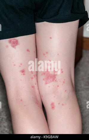 Vadnais Heights, Minnesota. 5 year old girl with infantigo.  This is commonly known as impetigo which is an infection caused by bacteria. Model releas Stock Photo