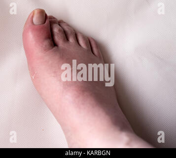 Big toe with gout, typical swelling, inflamation and skin peeling Stock Photo