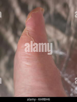 Big toe with gout, typical swelling, inflamation and skin peeling Stock Photo