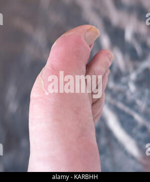 Big toe with gout, typical swelling, inflamation and skin peeling Stock Photo