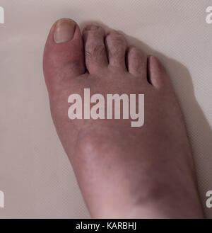 Big toe with gout, typical swelling, inflamation and skin peeling Stock Photo