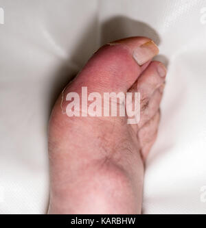 bIG TOE WITH GOUT Stock Photo