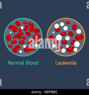 Leukemia vector icon illustration Stock Vector