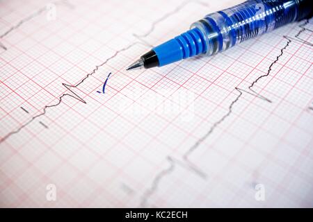 Close up of an electrocardiogram in paper form. Stock Photo