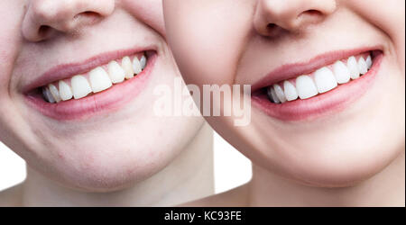 Teeth of young woman before and after whitening. Stock Photo