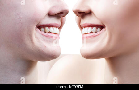 Teeth of young woman before and after whitening. Stock Photo