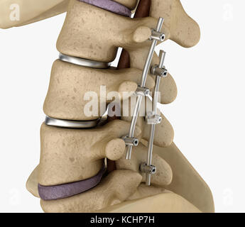 Spinal Fixation System - Titanium Bracket. X-ray View. 3D Illustration ...