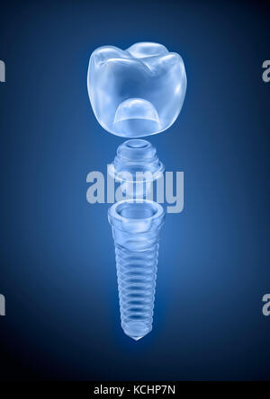 Dental titanium implant, x-ray view Stock Photo