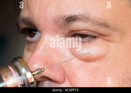 Examination of the sick eye and eyelid in the hospital. Doctor with injection treats the eyes of a man. Treatment of the diseased eye. Stock Photo