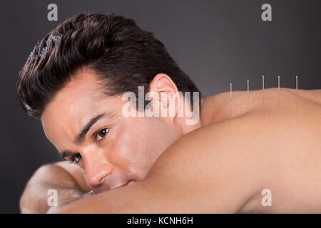 Close-up Of A Young Man Getting Acupuncture Treatment At Spa Stock Photo