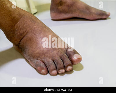 The feet of people with diabetes, dull and swollen. Due to the toxicity of diabetes. Stock Photo