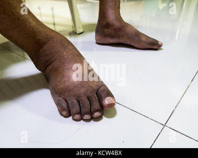 The feet of people with diabetes, dull and swollen. Due to the toxicity of diabetes. Stock Photo