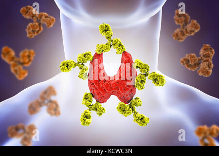 Autoimmune thyroiditis (Hashimoto's disease), conceptual illustration ...