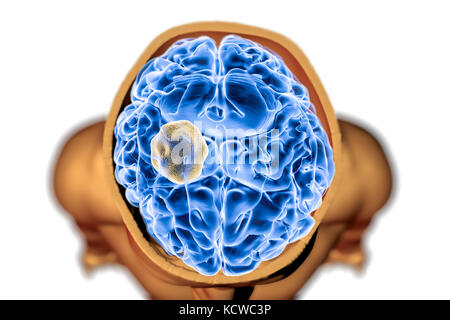Aspergilloma of the brain and close-up view of Aspergillus fungi, computer illustration. Also known as mycetoma, or fungus ball, this is an intracranial lesion produced by Aspergillus fungi in immunocompromised patients. Stock Photo