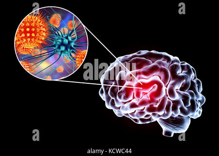 Viral encephalitis. Conceptual illustration showing brain and close-up view of viruses infecting neurons. Stock Photo