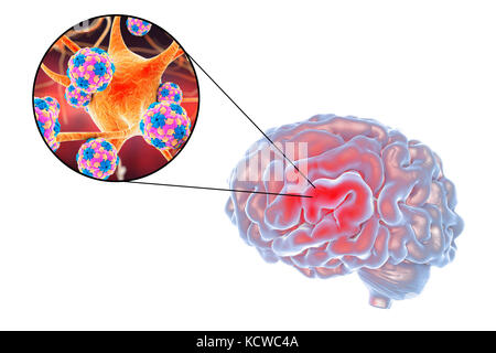 Viral encephalitis. Conceptual illustration showing brain and close-up view of viruses infecting neurons. Stock Photo